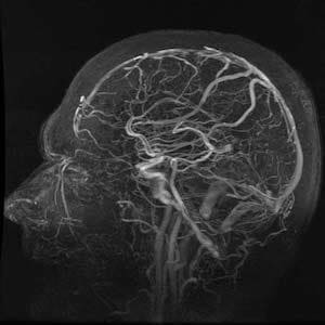 МРТ сосудов головного мозга снимок